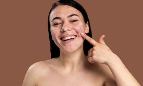 smiley-woman-showing-her-acne-with-confidence